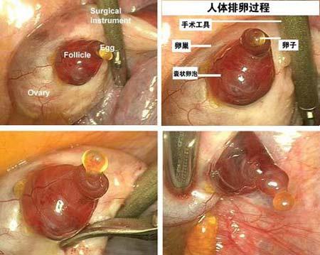 医生首次拍到人类排卵