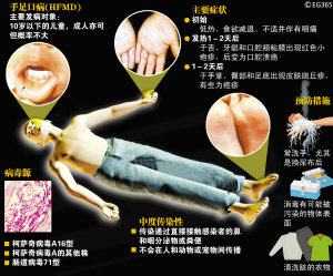 广东手足口病新增1例死亡病例