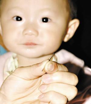 女婴胸部发现32mm缝衣针