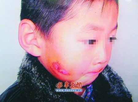 男童牛奶没喝光被老师烫脸