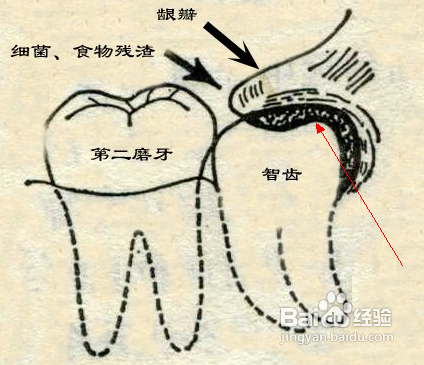 智齿冠周炎如何快速消炎_治疗感冒