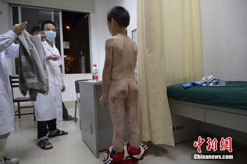 广东一男童遭继母家暴遍体鳞伤 警方已介入调查