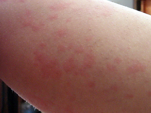 为预防小儿患上丘疹性荨麻疹