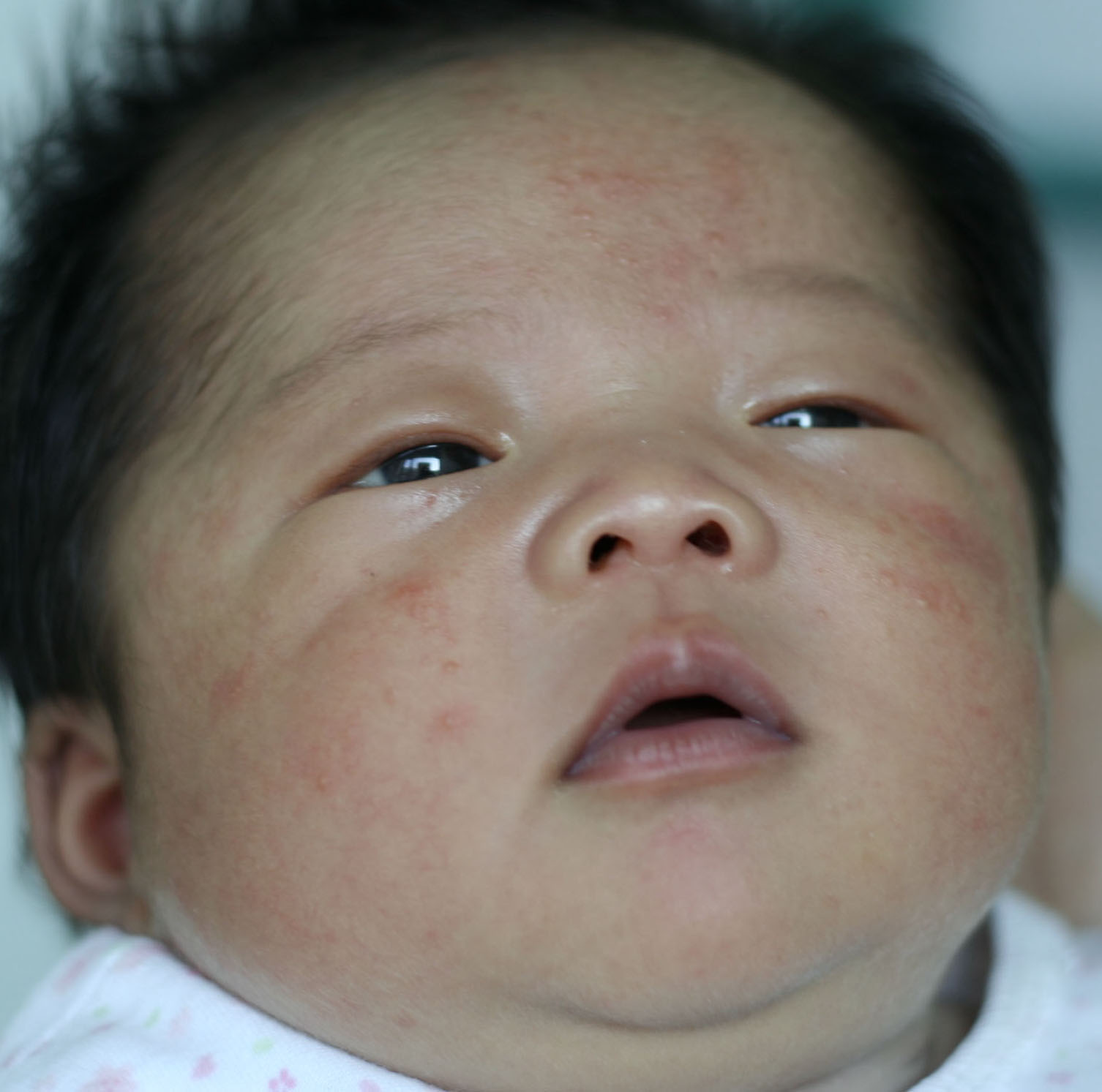 婴儿湿疹_婴儿疾病专区