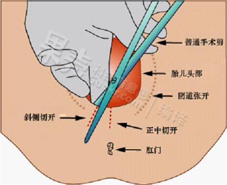 会阴侧切算是难产吗产妇不可不看