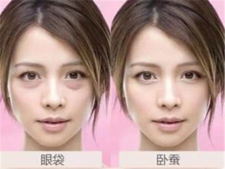 卧蚕和眼袋的区别