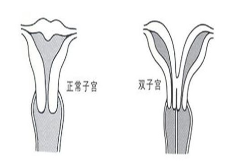 双子宫切除后注意什么 各个方面要注意