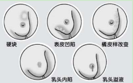 治疗乳腺纤维瘤吃什么药 乳腺纤维瘤禁吃什么