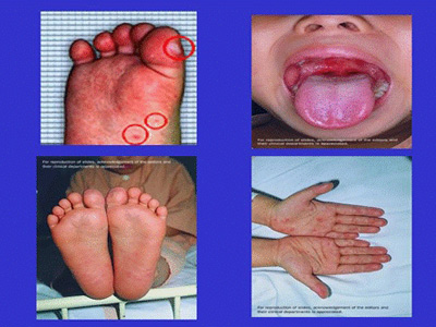 手足口病症状 手足口病图片